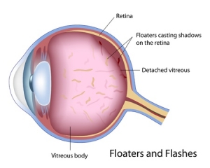 age, aged, aging, anatomy, biology, blind, cell, choroid, condition, cornea, cross section, detached, detachment, diagram, disease, disorder, eye, eye care, eyes, flashes, floating, health, healthcare, human, illustration, medical, medicine, ophthalmologist, ophthalmology, optic, optical, optometrist, optometry, organ, problem, pulling, retina, retinal, science, sclera, structure, tissue, vision, vision loss, vitreous, vitreous body